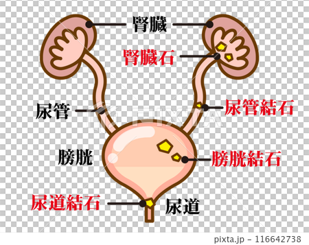 シンプルな尿路結石の図解イラスト素材 116642738