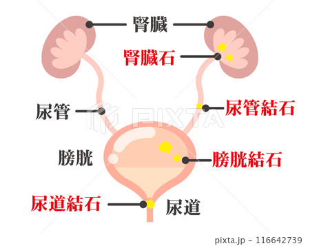 シンプルな尿路結石の図解イラスト素材2 116642739