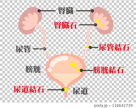 シンプルな尿路結石の図解イラスト素材2 116642739