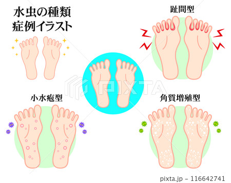 シンプルな水虫の症例図解イラスト素材セット シンプルな水虫の症例図解イラスト素材セット 116642741