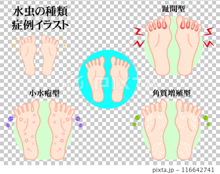 シンプルな水虫の症例図解イラスト素材セット シンプルな水虫の症例図解イラスト素材セット 116642741