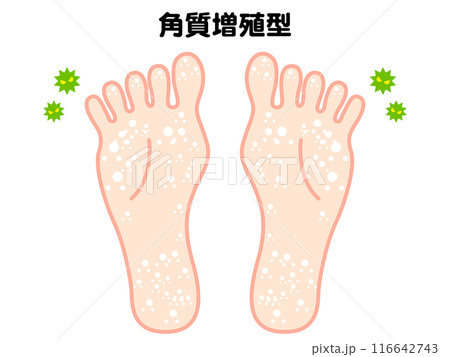 水虫になった足の裏のイラスト素材 水虫になった足の裏のイラスト素材 116642743