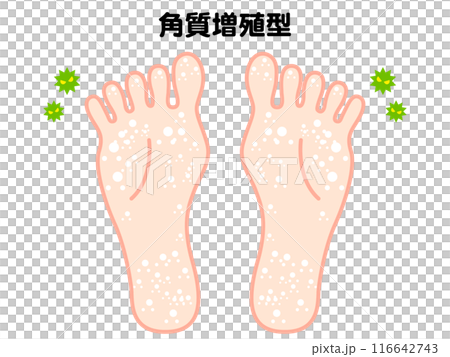水虫になった足の裏のイラスト素材 水虫になった足の裏のイラスト素材 116642743