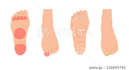 水虫がよく発症する部位のイメージイラストセット(足の裏と足の爪) 水虫がよく発症する部位のイメージイラストセット(足の裏と足の爪) 116645742