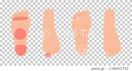 水虫がよく発症する部位のイメージイラストセット(足の裏と足の爪) 水虫がよく発症する部位のイメージイラストセット(足の裏と足の爪) 116645742