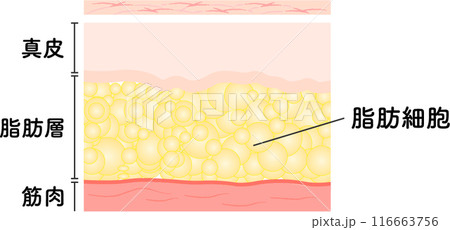 脂肪吸引 断面図 美容医療 美容整形 脂肪吸引 断面図 美容医療 美容整形 116663756