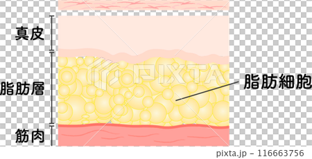 脂肪吸引 断面図 美容医療 美容整形 脂肪吸引 断面図 美容医療 美容整形 116663756