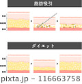 脂肪吸引　断面図　美容医療　美容整形　ダイエット 116663758
