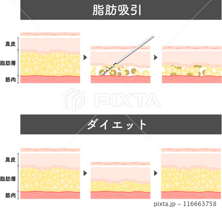 脂肪吸引　断面図　美容医療　美容整形　ダイエット 116663758