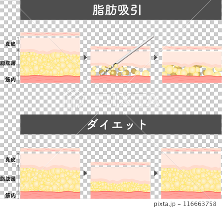 脂肪吸引　断面図　美容医療　美容整形　ダイエット 116663758