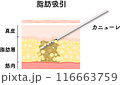 脂肪吸引　断面図　美容医療　美容整形　ダイエット 116663759