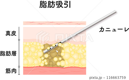 脂肪吸引　断面図　美容医療　美容整形　ダイエット 116663759