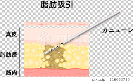 脂肪吸引　断面図　美容医療　美容整形　ダイエット 116663759
