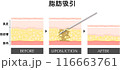 脂肪吸引　断面図　美容医療　美容整形　ダイエット 116663761