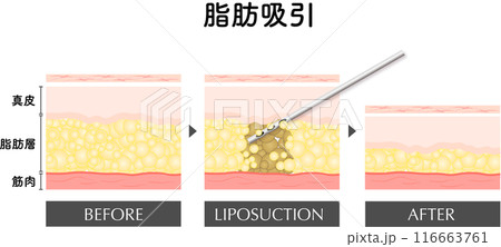 脂肪吸引 断面図 美容医療 美容整形 ダイエット 脂肪吸引 断面図 美容医療 美容整形 ダイエット 116663761