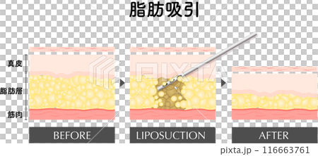 脂肪吸引 断面図 美容医療 美容整形 ダイエット 脂肪吸引 断面図 美容医療 美容整形 ダイエット 116663761