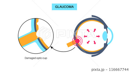 Damaged optic cup Damaged optic cup 116667744