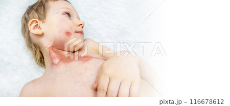 dressing a boy with a burn from boiling water dressing a boy with a burn from boiling water 116678612
