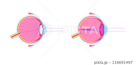 Cataract eye disease 116691497