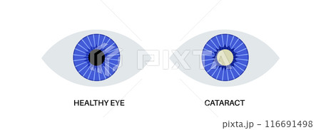 Cataract eye disease 116691498