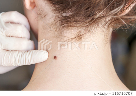 Woman examing her abnormal mole. Dermatology procedure. Doctor checking Woman examing her abnormal mole. Dermatology procedure. Doctor checking 116716707