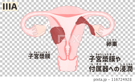 子宮体がんステージⅢA（3A期）　わかりやすい日本語図解イラスト 116724928