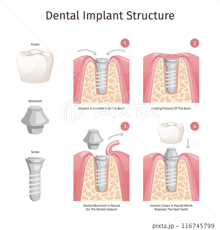 Dental implant structure. Tooth implantation procedure teeth replacement implants prosthesis parts abutment crown fixture screw dentistry medical diagram swanky illustration Dental implant structure. Tooth implantation procedure teeth replacement implants prosthesis parts abutment crown fixture screw dentistry medical diagram swanky illustration 116745799