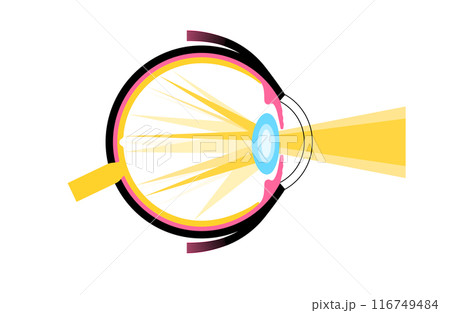 Cataract eye disease Cataract eye disease 116749484