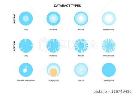 Cataract eye disease Cataract eye disease 116749486