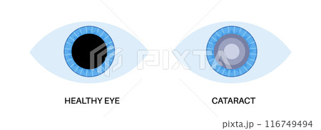 Cataract eye disease 116749494