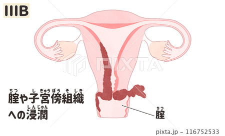 子宮体がんステージⅢB（3B期）　わかりやすい日本語図解イラスト 116752533