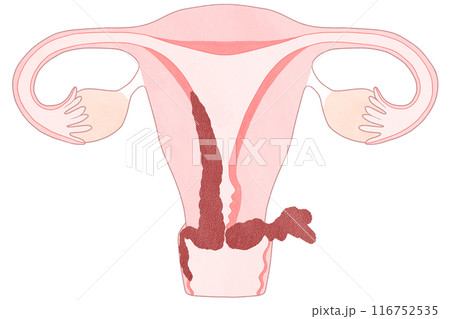 子宮体がんステージⅢB（3B期）　わかりやすい図解イラスト 116752535