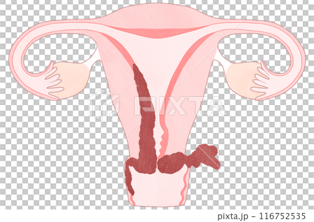 子宮体がんステージⅢB（3B期）　わかりやすい図解イラスト 116752535