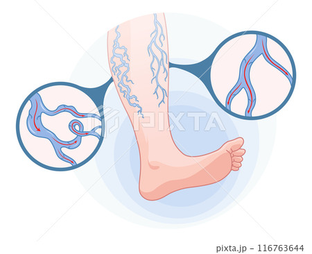 Varicose veins. Blue blood vessel visible through the skin, abnormally swollen leg. Vascular disease diagnostic and treatment. Venous insufficiency medical disease 116763644