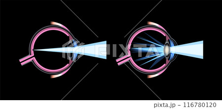 Cataract eye disease 116780120