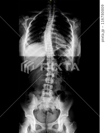 X-ray of idiopathic S-shaped scoliosis of thoracic and lumbar spine. Part of skeleton with spinal curvature on black background. Lateral backbone deformation. Radiological image of back and pelvis X-ray of idiopathic S-shaped scoliosis of thoracic and lumbar spine. Part of skeleton with spinal curvature on black background. Lateral backbone deformation. Radiological image of back and pelvis 116780809