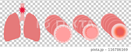 Illustration of bronchi and lungs asthma disease image 116786169