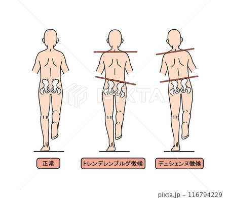 トレンデレンブルグ徴候とデュシエンヌ徴候(文字あり) トレンデレンブルグ徴候とデュシエンヌ徴候(文字あり) 116794229