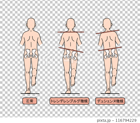 トレンデレンブルグ徴候とデュシエンヌ徴候(文字あり) トレンデレンブルグ徴候とデュシエンヌ徴候(文字あり) 116794229
