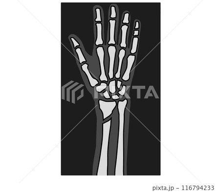 骨折のレントゲン 116794233