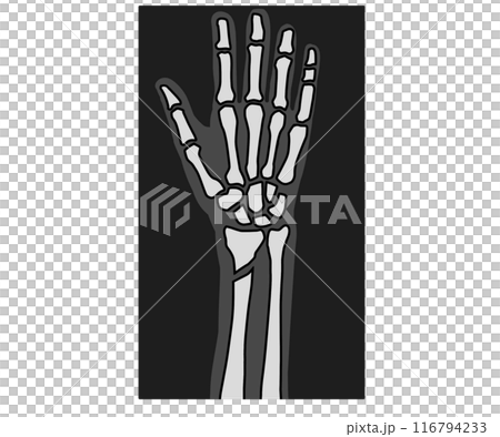 骨折のレントゲン 116794233