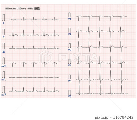 正常十二誘導心電図 正常十二誘導心電図 116794242