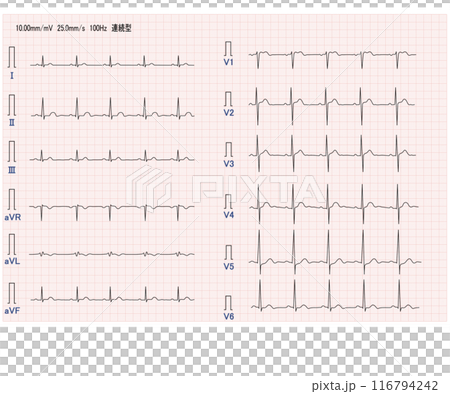正常十二誘導心電図 正常十二誘導心電図 116794242