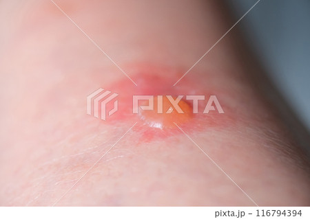 虫刺されのイメージ 虫刺されのイメージ 116794394