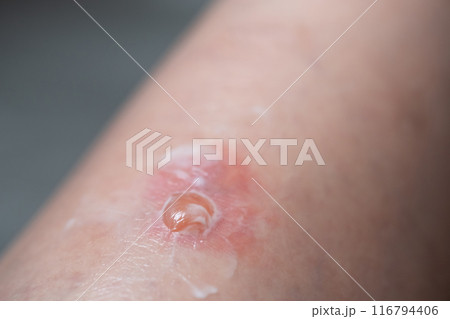 虫刺されのイメージ 虫刺されのイメージ 116794406
