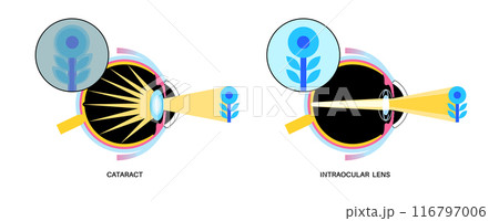 Intraocular lenses poster 116797006