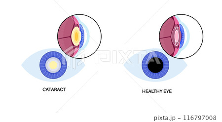 Intraocular lenses poster 116797008