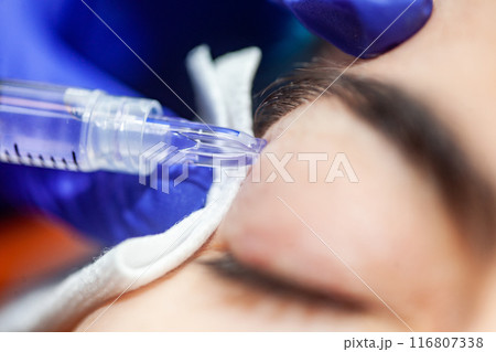 Female patient receiving a mesotherapy hydration procedure on eyelids with microneedles at dermatologist office. Female patient receiving a mesotherapy hydration procedure on eyelids with microneedles at dermatologist office. 116807338