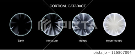 Cataract eye disease 116807894