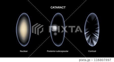Cataract eye disease 116807897
